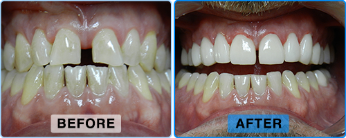 Before and after: a gap between the upper front teeth closed, leaving an even, brighter smile