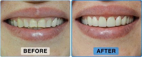 Before and after: uneven, yellowed upper front teeth reshaped into a brighter, more even smile