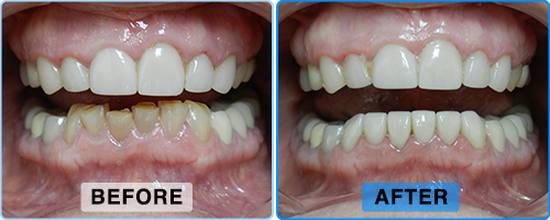 Before and after: worn and stained teeth restored to an even, brighter smile