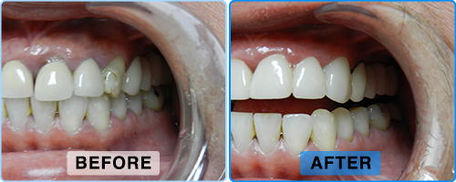 Before and after, side view: darkened and uneven teeth restored to a brighter, even line