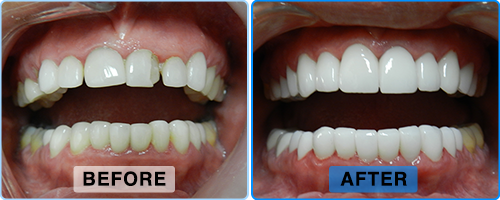 Before and after: chipped and stained teeth restored to a full, bright, even smile